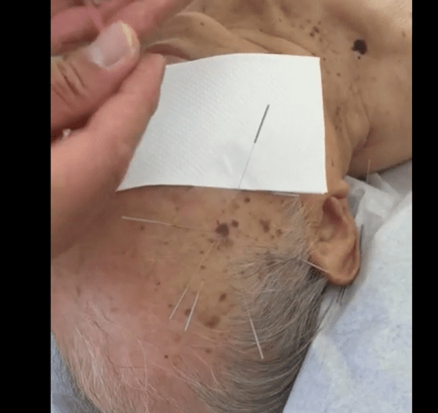 How to remove moles with acupuncture and moxibustion