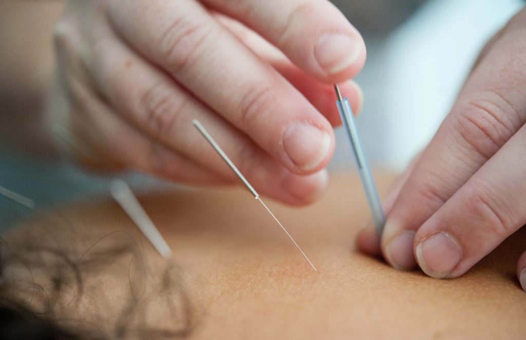 CHINESE MEDICINE ACUPUNCTURE NEAR ME